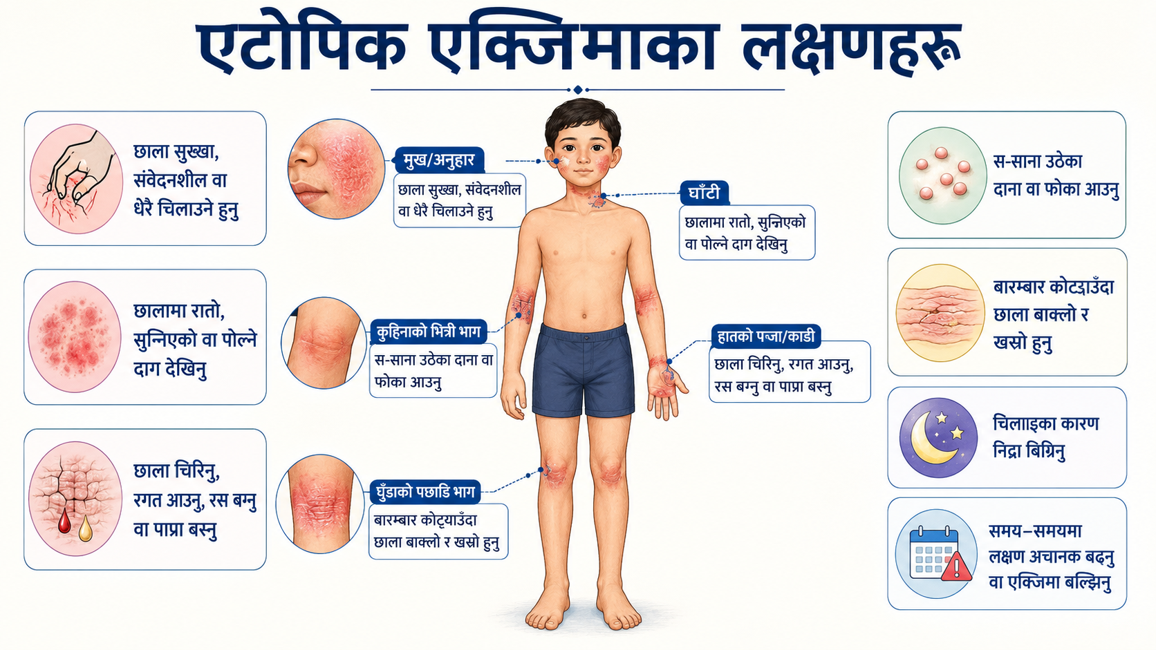 Atopic eczema - Symptoms