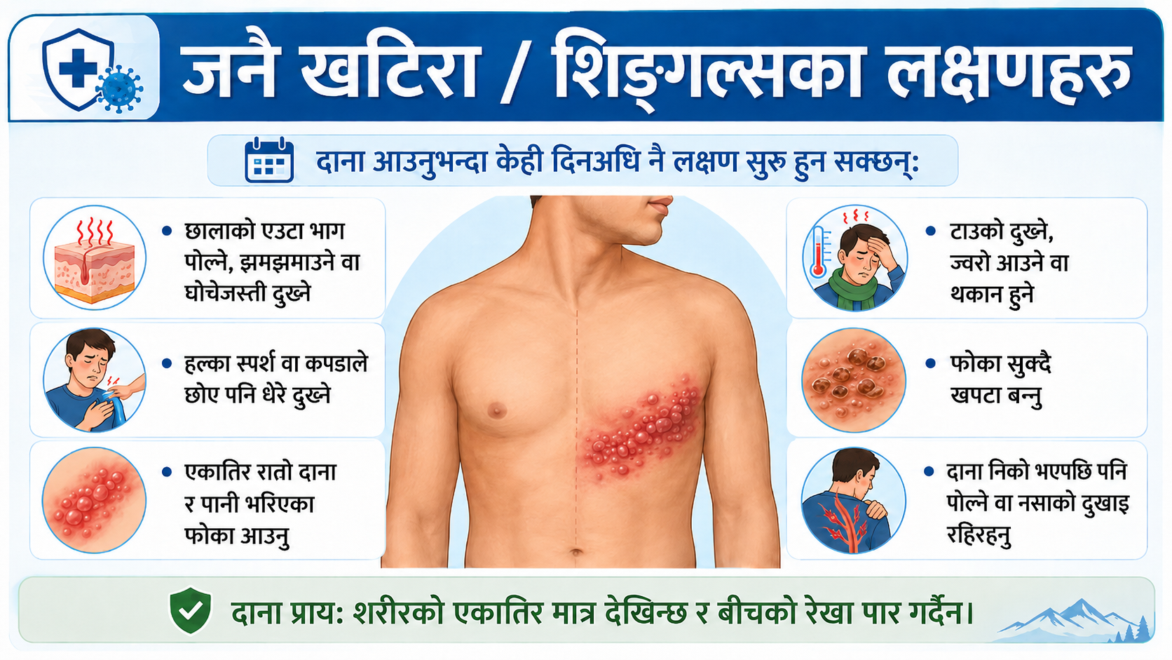 Shingles - Symptoms
