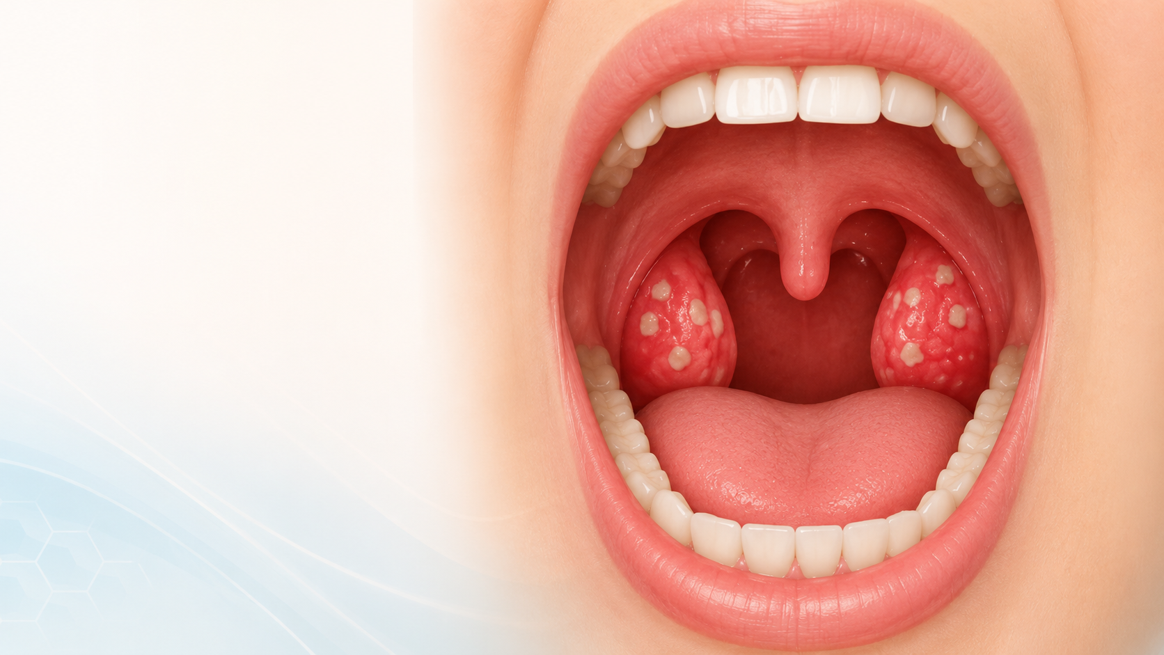 Tonsillitis